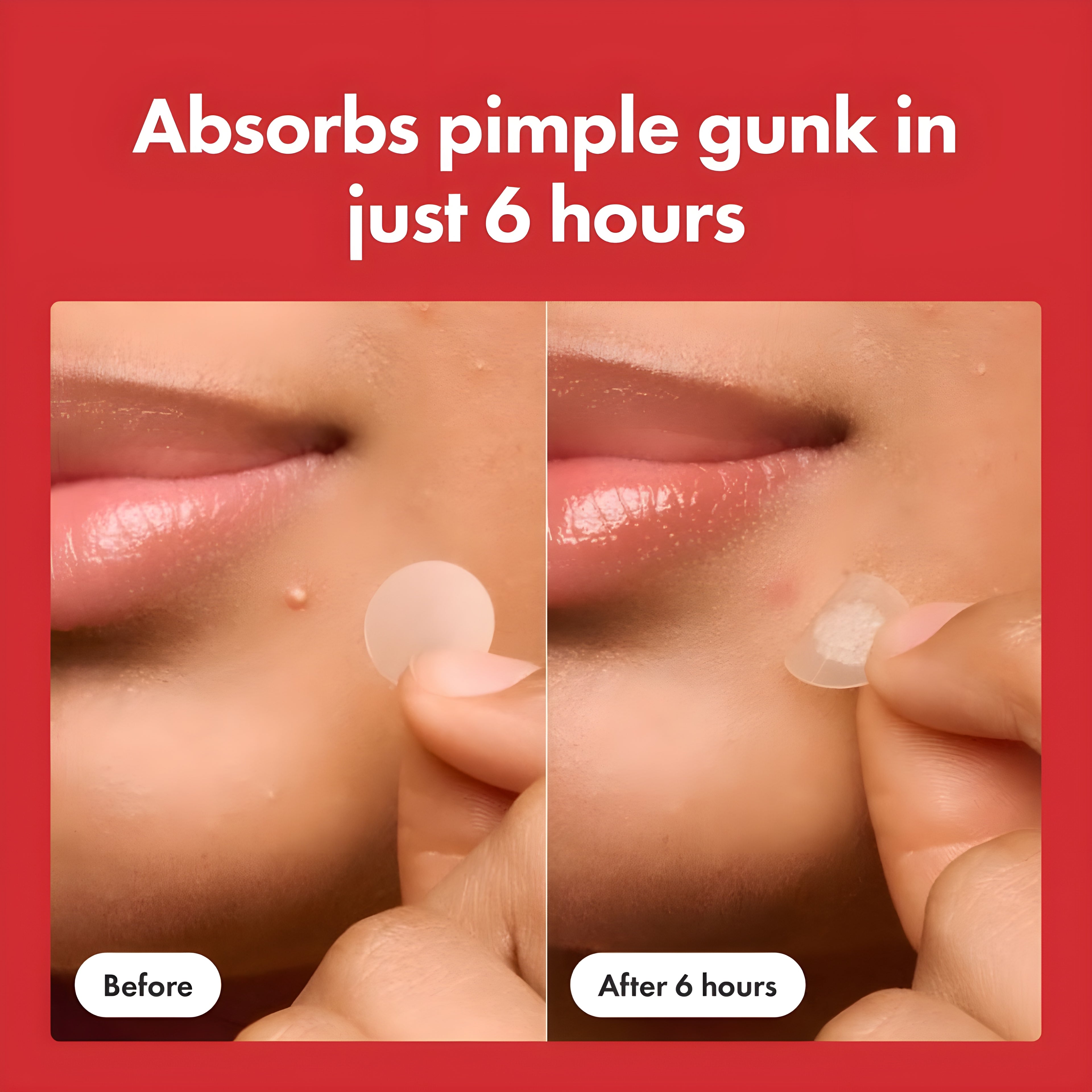 HERO Mighty Pimple Patch